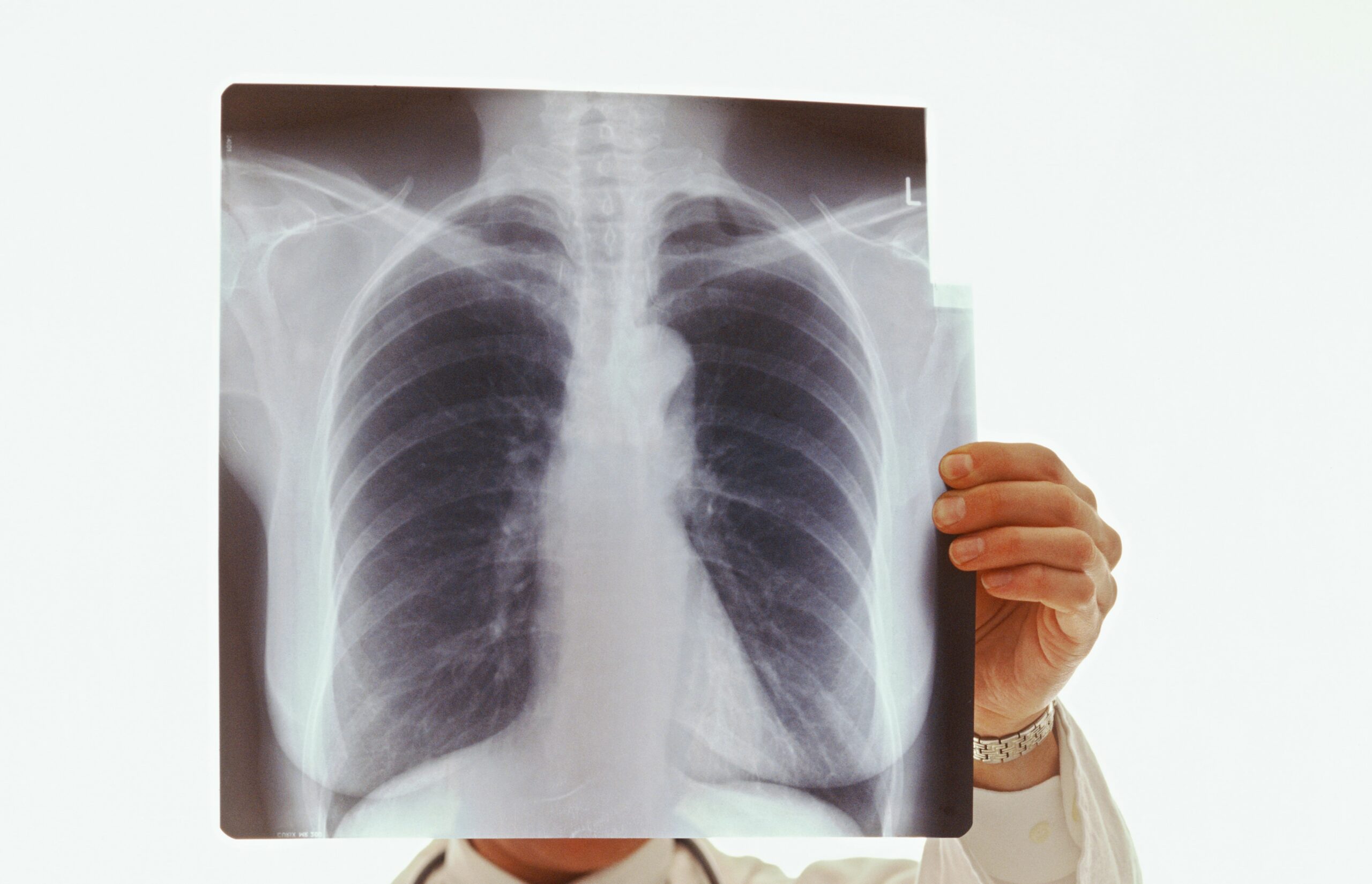 Lung x-ray being held up tot he light by doctor