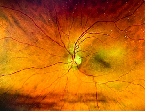 Vascular ‘fingerprint’ at the back of the eye can accurately predict stroke risk