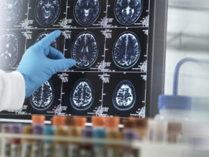 Alzheimers and dementia brain scans with a hand pointing at the screen