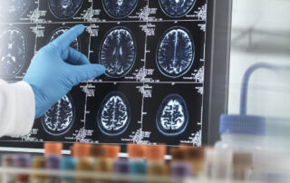 Alzheimers and dementia brain scans with a hand pointing at the screen
