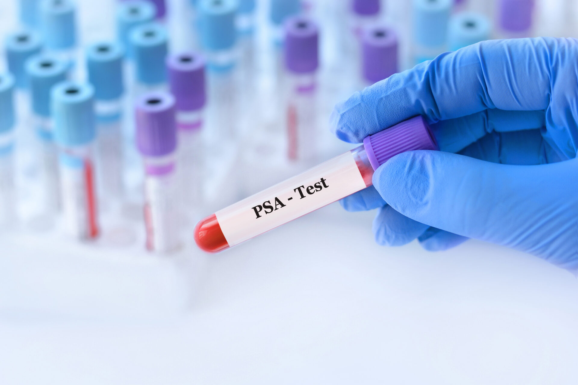 Doctor holding a test blood sample tube with PSA Prostate Specific Antigen test on the background of medical test tubes with analyzes
