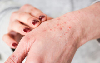 Close-up of a hand showing numerous small red bumps and irritated skin on the back of the hand.