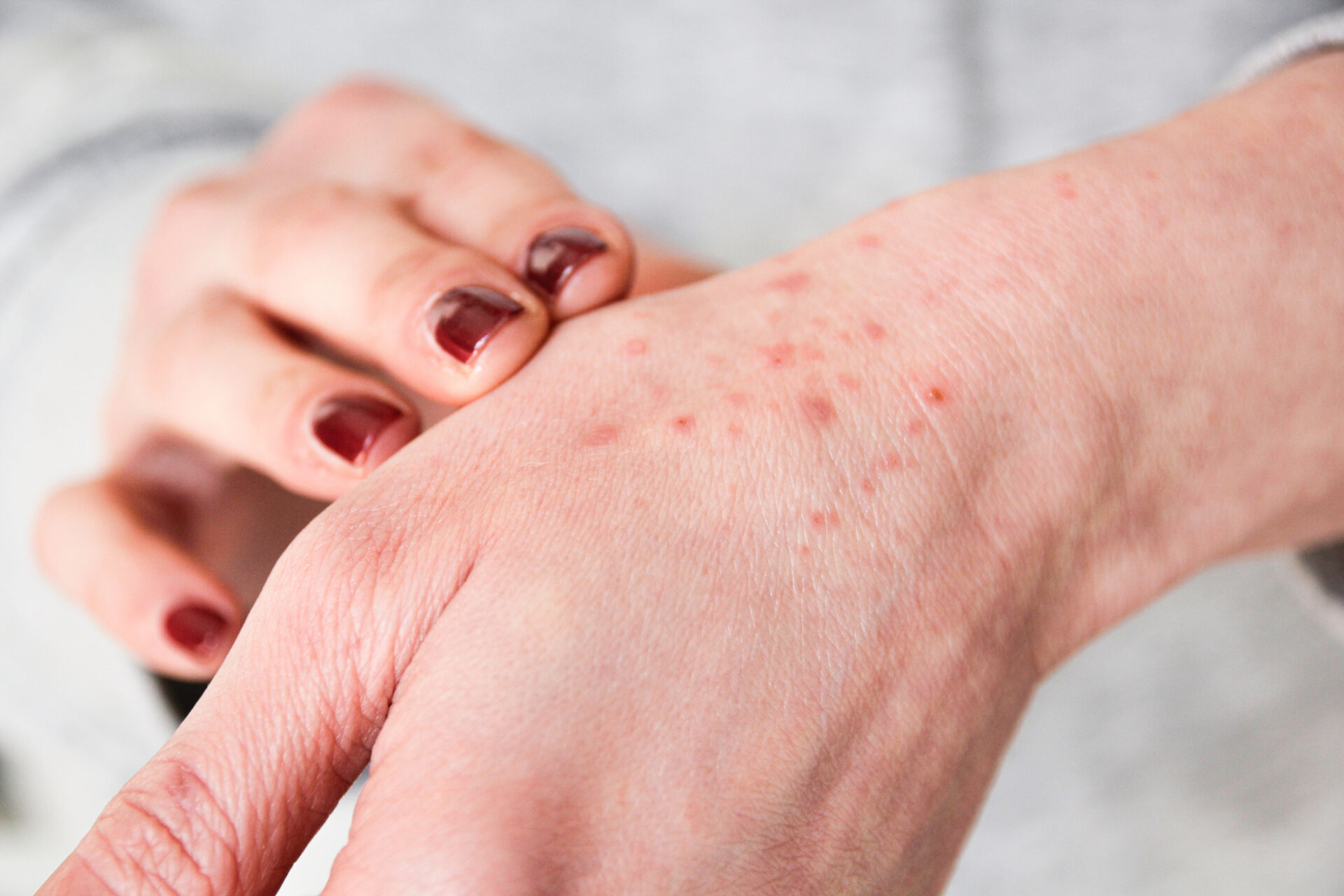 Close-up of a hand showing numerous small red bumps and irritated skin on the back of the hand.