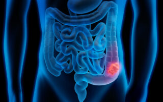 3D blue illustration of the digestive system focusing on intestines; appendix area is highlighted in pink.