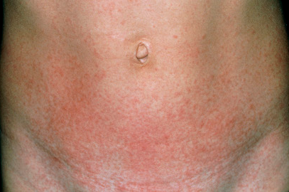 Close-up of a person's midsection (abdomen/neck) showing a widespread red, irritated rash across the skin.